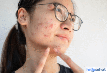 Hilangkan Bekas Jerawat Hitam Membandel di Pipi? 10 Cara Ampuh!