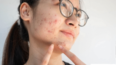 Hilangkan Bekas Jerawat Hitam Membandel di Pipi? 10 Cara Ampuh!