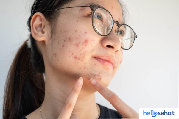 Hilangkan Bekas Jerawat Hitam Membandel di Pipi? 10 Cara Ampuh!