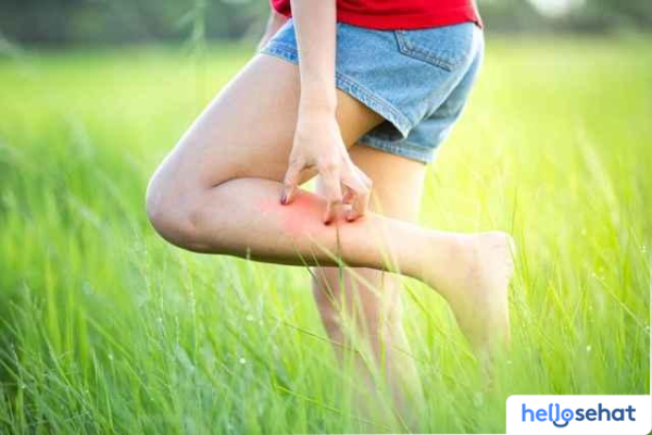 Obat Sengatan Tawon Ampuh? Atasi Cepat dengan Pertolongan Pertama Ini