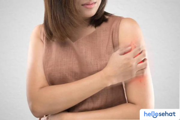 Obat Terkena Bahan Kimia? Atasi Cepat Dengan Pertolongan Pertama Ini