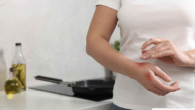 Obati Luka Bakar Minyak Panas: 7 Tips Ampuh Cepat Sembuh