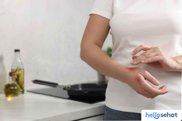 Obati Luka Bakar Minyak Panas: 7 Tips Ampuh Cepat Sembuh