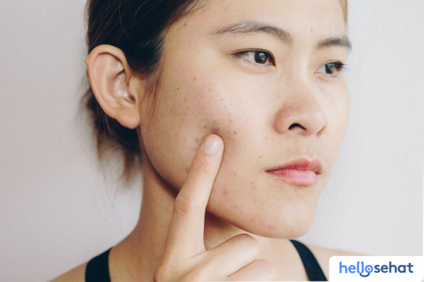 Purging vs Breakout: Kenali Perbedaannya & Atasi Masalah Kulit